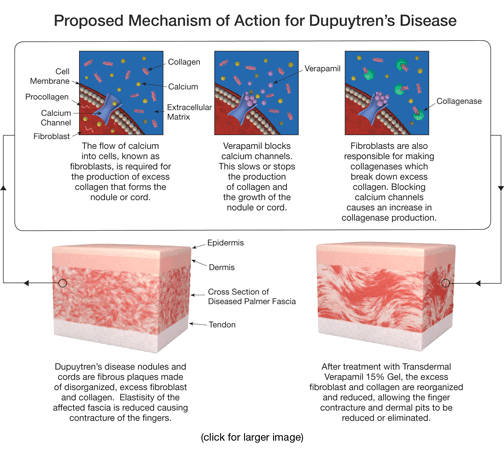 Proposed mechanism of action for Dupuytren's disease illustration
