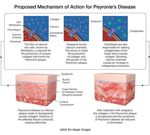 Proposed mechanism of action for Peyronie's disease illustration