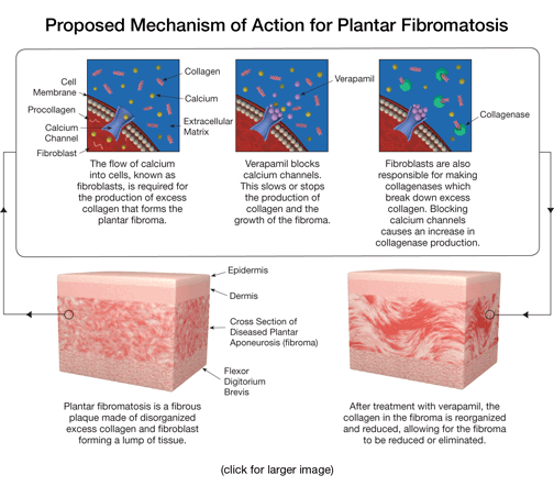 Proposed mechanism of action for plantar fibromatosis illustration